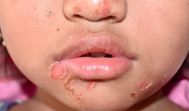 Et barn med børnesår om munden