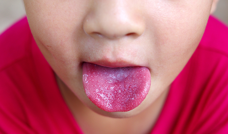 Et barn med skarlagensfeber rækker tunge
